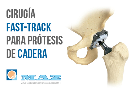 El Hospital MAZ de Zaragoza implementa el programa de cirugía “fast track” para las prótesis de cadera