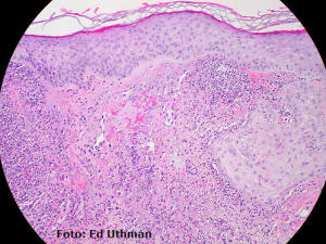 Dermatosis